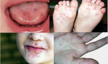 Itaúna confirma surto de Síndrome Mão-Pé-Boca em creches e escolas