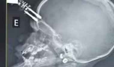 Carregador de celular perfura crânio de bebê de um ano