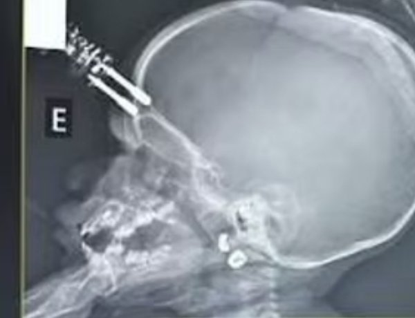 Carregador de celular perfura crânio de bebê de um ano