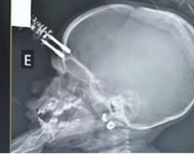 Carregador de celular perfura crânio de bebê de um ano